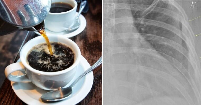 30yo Woman Who Drinks Over 10 Cups of Coffee Daily Finds Out Her Bones Are Like A 60yo - WORLD OF BUZZ 1