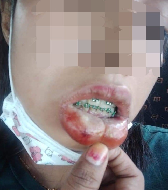 M'sian Gets Cheap & Fake Braces, Suffers From Swollen Lips, High Fever & Bed Ridden For 3 Days - WORLD OF BUZZ 1