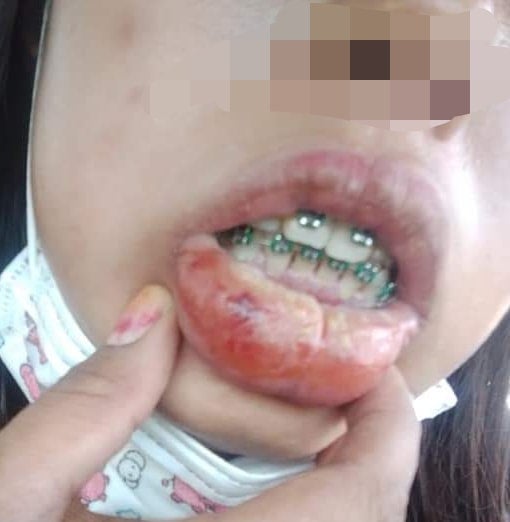 M'sian Gets Cheap & Fake Braces, Suffers From Swollen Lips, High Fever & Bed Ridden For 3 Days - WORLD OF BUZZ 2