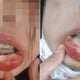 M'Sian Gets Cheap &Amp; Fake Braces, Suffers From Swollen Lips, High Fever &Amp; Bed Ridden For 3 Days - World Of Buzz 3