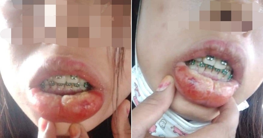 M'sian Gets Cheap & Fake Braces, Suffers From Swollen Lips, High Fever & Bed Ridden For 3 Days - WORLD OF BUZZ 3