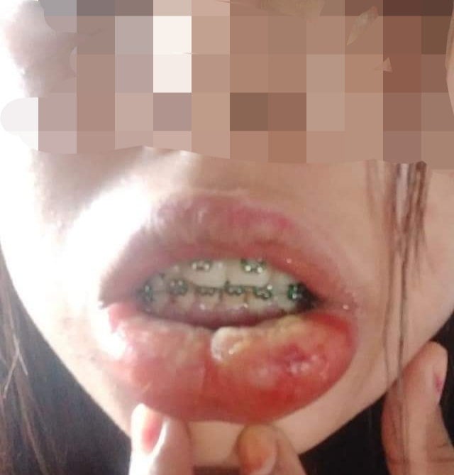 M'sian Gets Cheap & Fake Braces, Suffers From Swollen Lips, High Fever & Bed Ridden For 3 Days - WORLD OF BUZZ