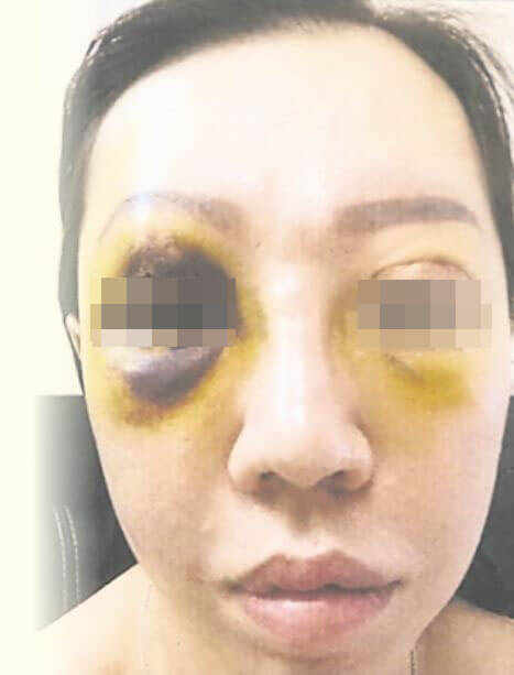 M'sian Woman Suffers a Swollen Right Eye After Undergoing Double Eyelid Surgery - WORLD OF BUZZ 1