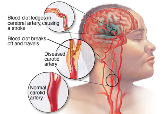 Shocking Study Finds Strokes Can Strike People In Their 30's And Below - WORLD OF BUZZ