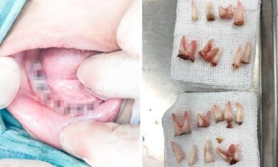 Dentist Shares How 4Yo Boy Hardly Brushes Teeth Before Bed, Now Only Left With 2 Teeth - World Of Buzz