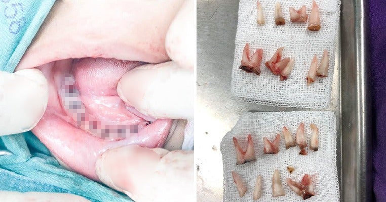Dentist Shares How 4Yo Boy Hardly Brushes Teeth Before Bed, Now Only Left With 2 Teeth - World Of Buzz