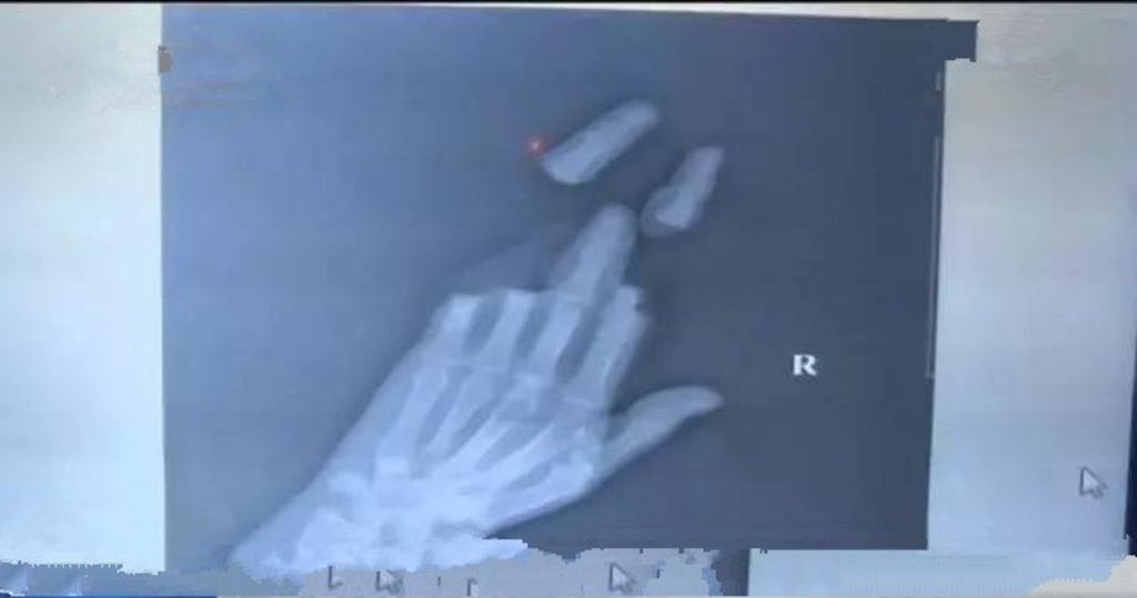 Man Flying Kite Gets 3 Fingers Shockingly Sliced Off When He Wanted to Reel It Back In - WORLD OF BUZZ 1