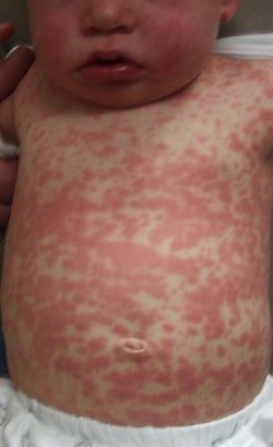 Over 20 Million Children Are Missing Their Measles Shots Every Year, Causing Outbreaks - WORLD OF BUZZ 1