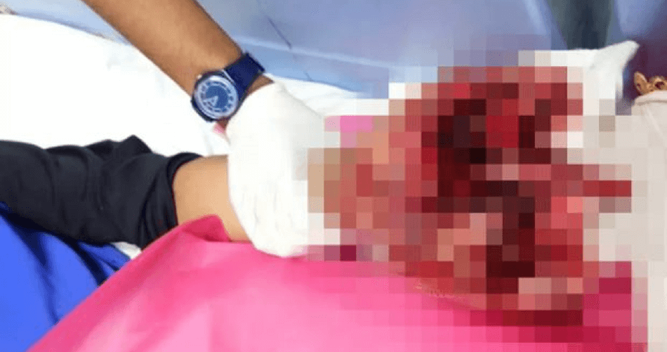 13Yo Malaysian Boy Loses All 5 Fingers While Playing With Firecrackers During Ramadan - World Of Buzz 2