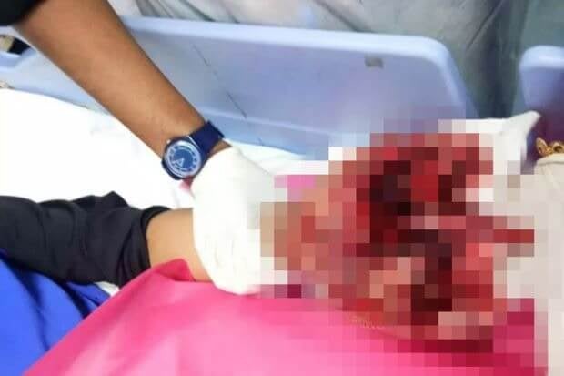 13Yo Malaysian Boy Loses All 5 Fingers While Playing With Firecrackers During Ramadan - World Of Buzz