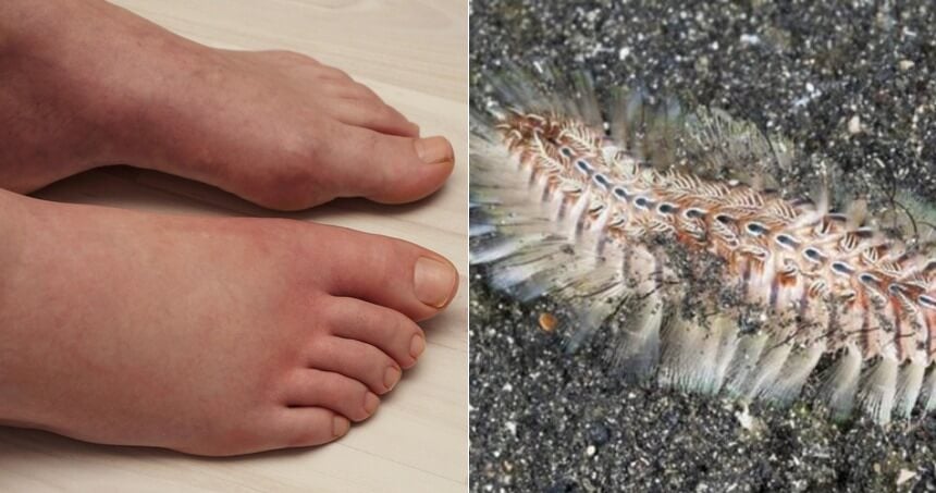 36Yo Man'S Left Leg Paralysed For Life After He Was Stung By A Golden Fireworm In Pangkor - World Of Buzz 2