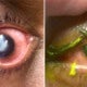 Doctor Shares How Woman'S Cornea Gets Eaten Away By Bacteria After Sleeping In Contact Lenses - World Of Buzz