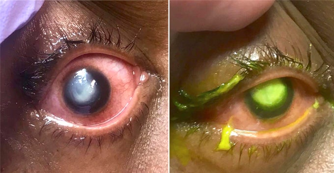 Doctor Shares How Woman'S Cornea Gets Eaten Away By Bacteria After Sleeping In Contact Lenses - World Of Buzz