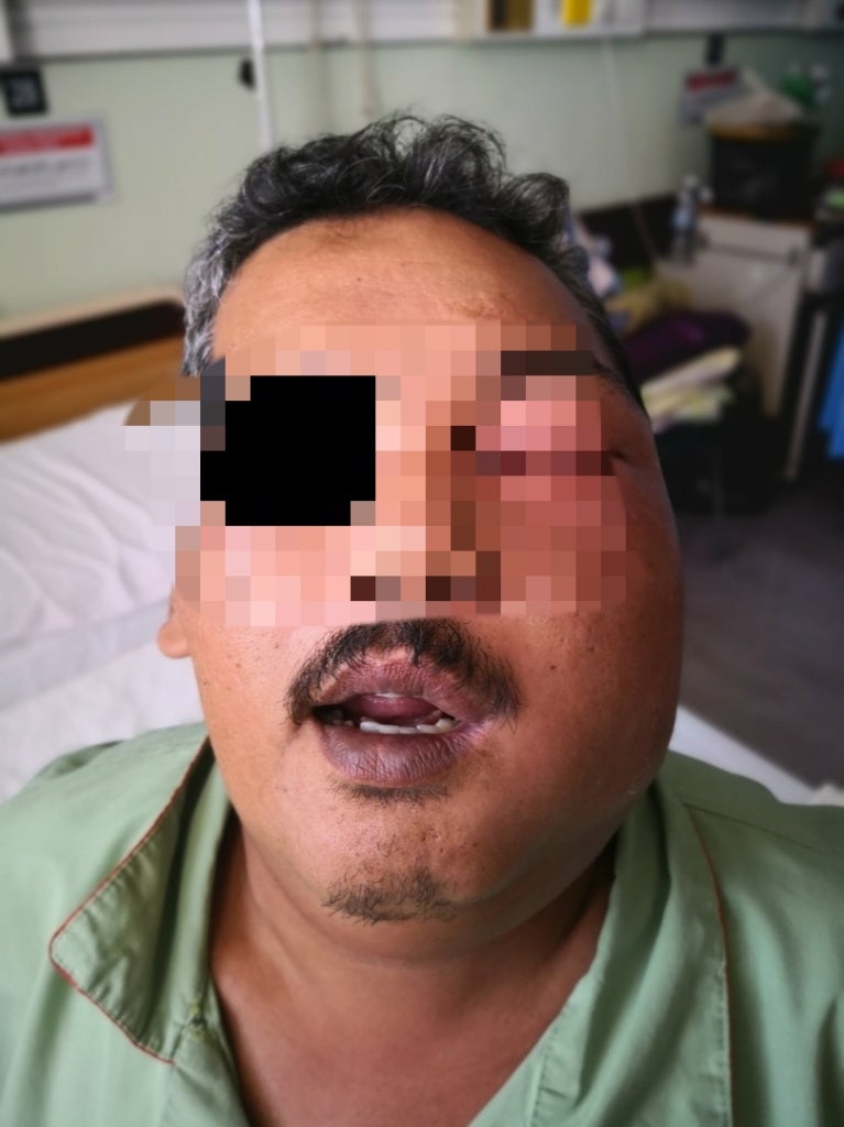 Man Applies Brake Fluid To Cure His Toothache, Got Admitted Into ICU Because Of Severe Infection - WORLD OF BUZZ 1