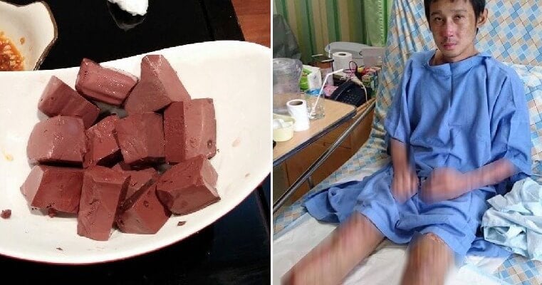 Man Loses Both Legs After He Contracted Deadly Infection From Eating Pigs Blood World Of Buzz 4