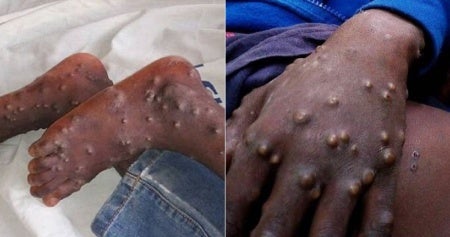 Man Tested Postive For Monkeypox In Singapore 23 People Quarantined For 21 Days World Of Buzz 1 E1557740978714