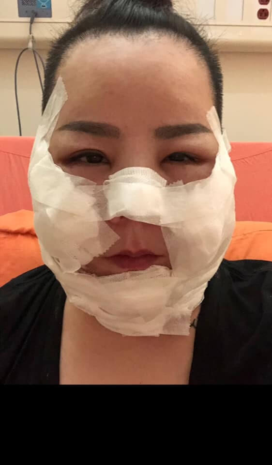 Woman Badly Disfigured & Scarred After Suffering Second-Degree Burns From Facelift - WORLD OF BUZZ 3