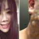 Woman Badly Disfigured &Amp; Scarred After Suffering Second-Degree Burns From Facelift - World Of Buzz 4