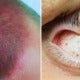 Boy Left With Bruised Head &Amp; Burst Eye Blood Vessels After Violently Spinning On Swings - World Of Buzz