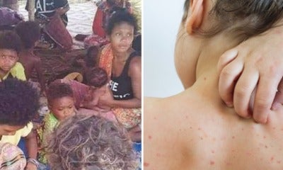 Deaths Among Orang Asli Were Due To Measles, Ministry Of Health Explains Importance Of Vaccines - World Of Buzz