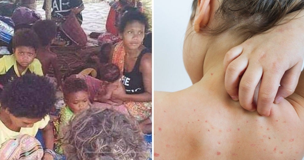 Deaths Among Orang Asli Were Due to Measles, Ministry Of Health Explains Importance Of Vaccines - WORLD OF BUZZ