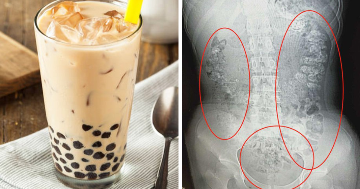 Doctors Shocked To Discover 14Yo Girl Has Hundreds Of Bubble Tea Pearls Lining Her Stomach - World Of Buzz 1