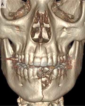 Guy's Jaw and Teeth Gets Shattered After Vape Pen Exploded in His Mouth - WORLD OF BUZZ