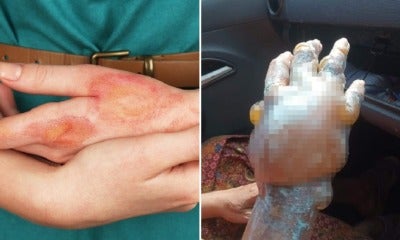 Malaysian Doctor Warns That Using Home Remedies Such As Toothpaste On Burns Is A Seriously Bad Idea - World Of Buzz