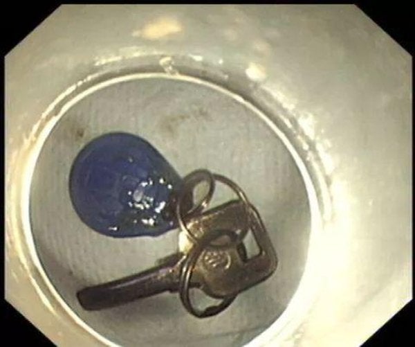 Man Gets So Drunk He Lost His Keys, Turns Out He Swallowed Them Instead - WORLD OF BUZZ 1