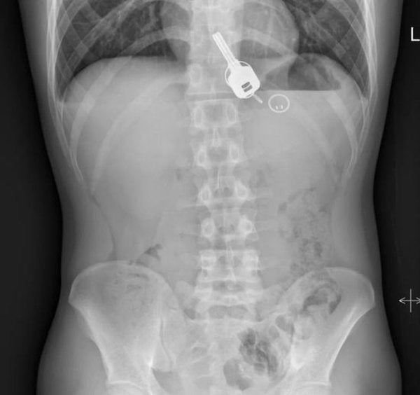 Man Loses His Keys After Drinking With Friends, Turns Out He Had Swallowed Them Instead - WORLD OF BUZZ