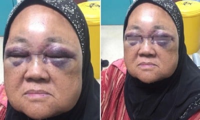 69Yo Malaysian Risks Being Blind After Grandson Punches Her Eyes When His Baby Cried - World Of Buzz 2