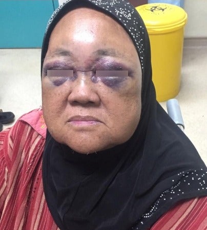 69yo Malaysian Risks Being Blind After Grandson Punches Her Eyes When His Baby Cried - WORLD OF BUZZ