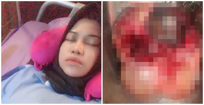 Alor Setar Woman Developed Two Huge Ovarian Cysts Due To Eating Too Much Fast Food - World Of Buzz