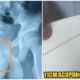 Boy Inserts 11Cm Needle Into Urethra In Order To Stay Awake To Complete His Assignments - World Of Buzz 7