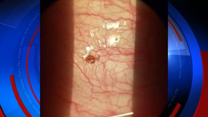 Electrical Worker Who Always Uses Insect Repellent Finds A Tick Inside His Cornea - WORLD OF BUZZ 1