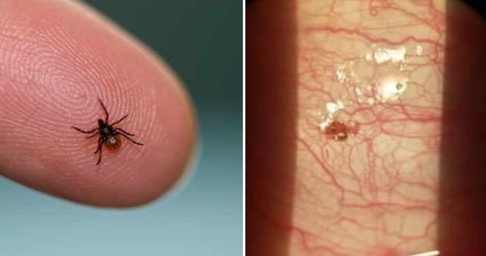 Electrical Worker Who Always Uses Insect Repellent Finds A Tick Inside His Cornea - World Of Buzz 3