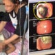 9Yo Found To Have 18Cm Diameter Hairball In Stomach After Mother Notices Her Balding - World Of Buzz