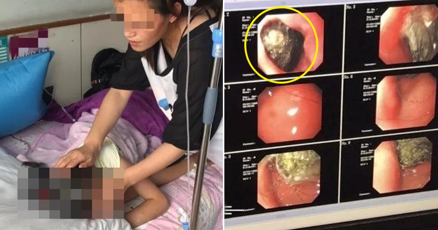 9Yo Found To Have 18Cm Diameter Hairball In Stomach After Mother Notices Her Balding - World Of Buzz
