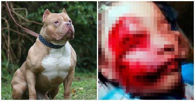Johor Girl Hospitalised After Being Attacked By Neighbour'S Mixed Breed Pitbull - World Of Buzz