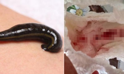 Woman Warns Parents After Leech Entered Her 4Yo Daughter'S Vagina &Amp; Sucked Her Blood - World Of Buzz