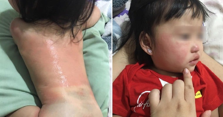 Malaysian Toddler Experiences Red &Amp; Itchy Body After Mother Forgot To Disinfect Baby Chair - World Of Buzz 2