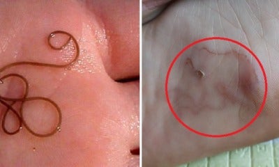 Malaysian Woman Gets Worm Infection In Her Foot After Family Vacation In Port Dickson - World Of Buzz
