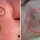 Malaysian Woman Gets Worm Infection In Her Foot After Family Vacation In Port Dickson - World Of Buzz