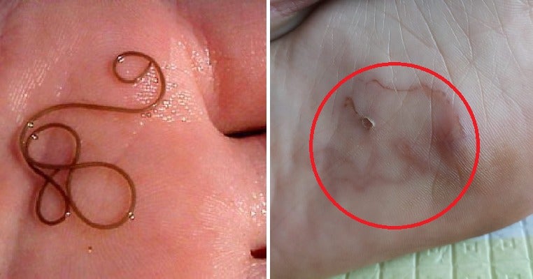 Malaysian Woman Gets Worm Infection in Her Foot After Family Vacation in Port Dickson - WORLD OF BUZZ