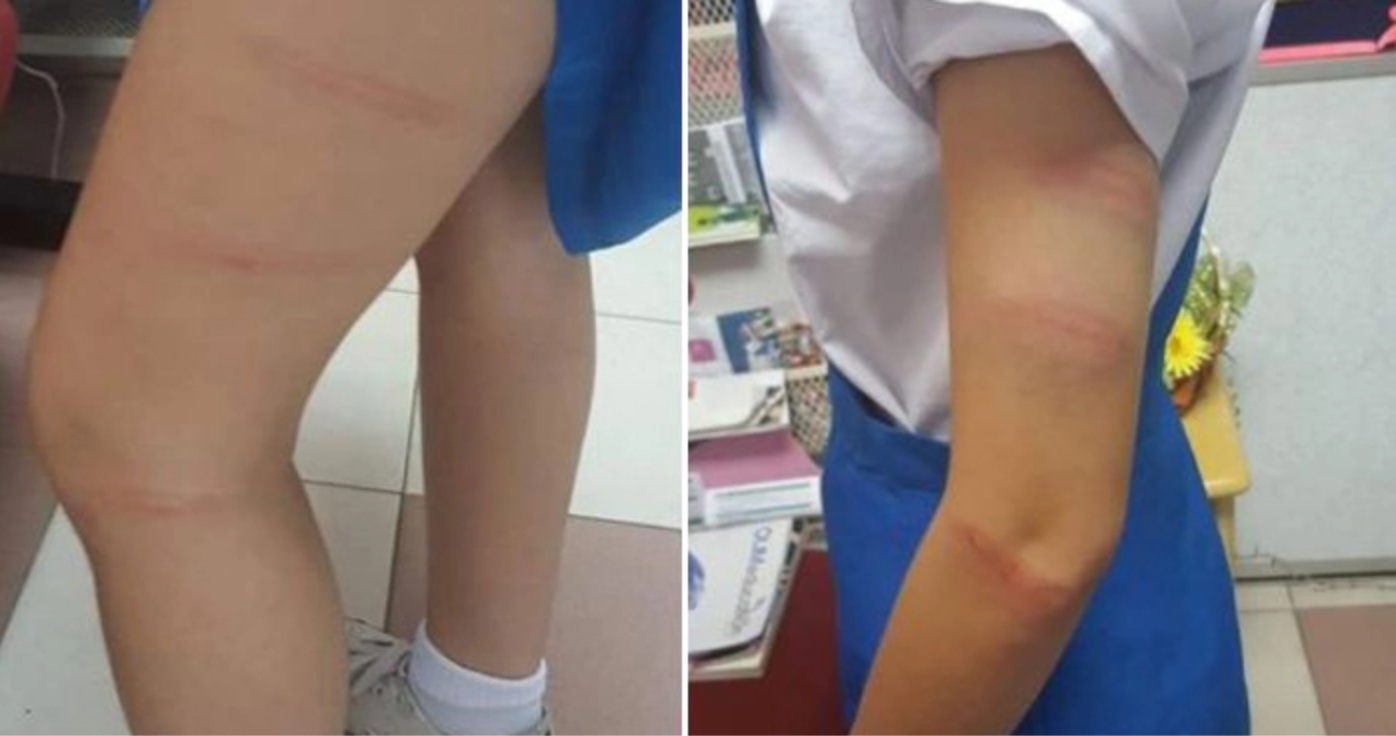 Mother Makes Police Report Because A Teacher Caned Her 11yo Daughter Once on The Palm - WORLD OF BUZZ