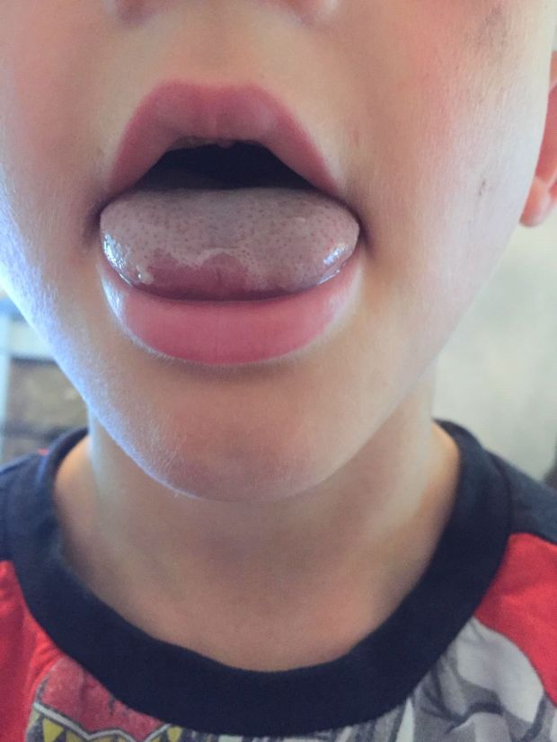 Mother Warns Others After 6yo Son Gets Tongue Stuck in Water Bottle Lid, Nearly Died - WORLD OF BUZZ 4