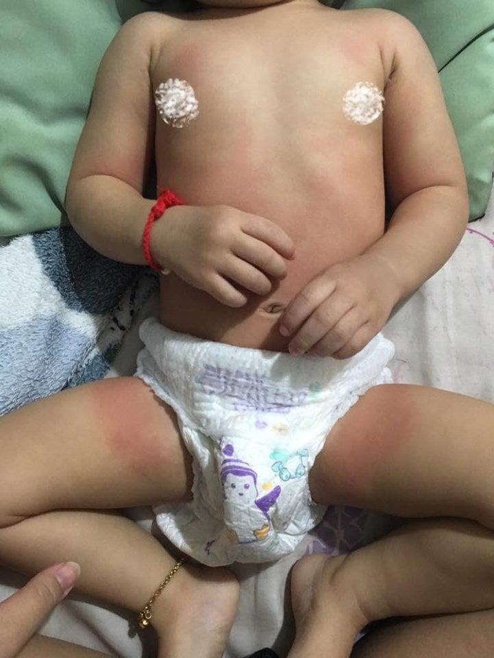 M'sian Mother Shares Why Disinfecting Baby Chair is Important After Baby Suffers Severe Reaction - WORLD OF BUZZ