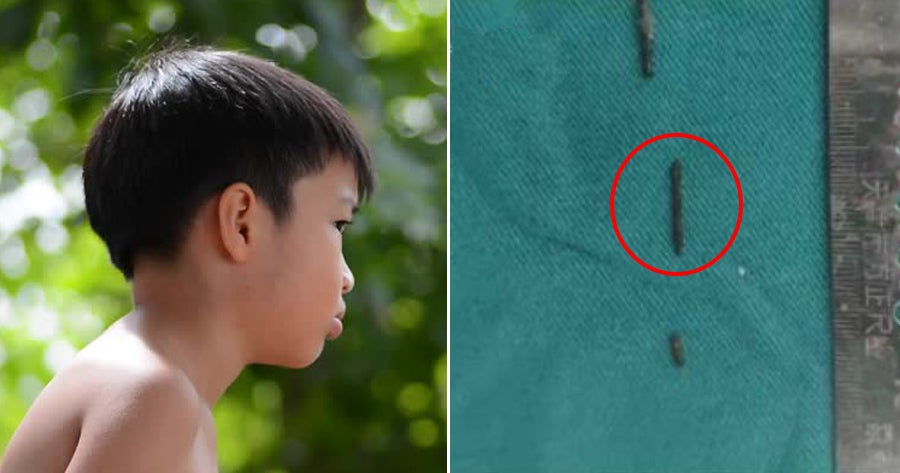 8Yo Boy Shocked To Find 3 Broken Pieces Of Sewing Needle In His Neck, No Clue How It Got There - World Of Buzz