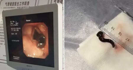 woman coughs out blood doctor finds 3cm leech in her throat world of buzz 2 1 e1564547654180