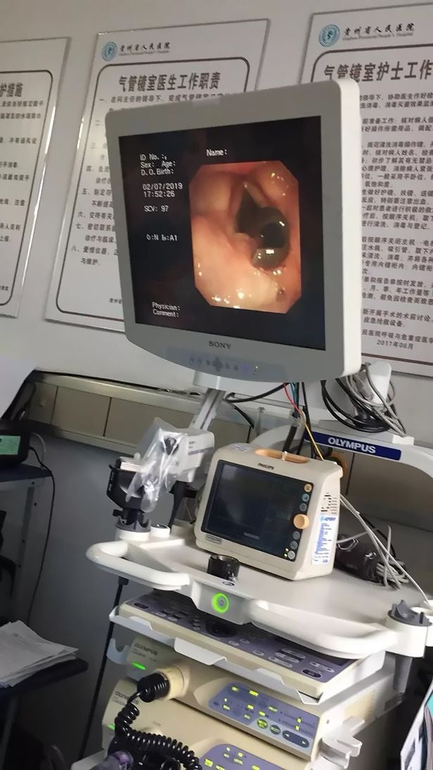 Woman Coughs Out Blood, Doctor Finds 3cm Leech In Her Throat - WORLD OF BUZZ